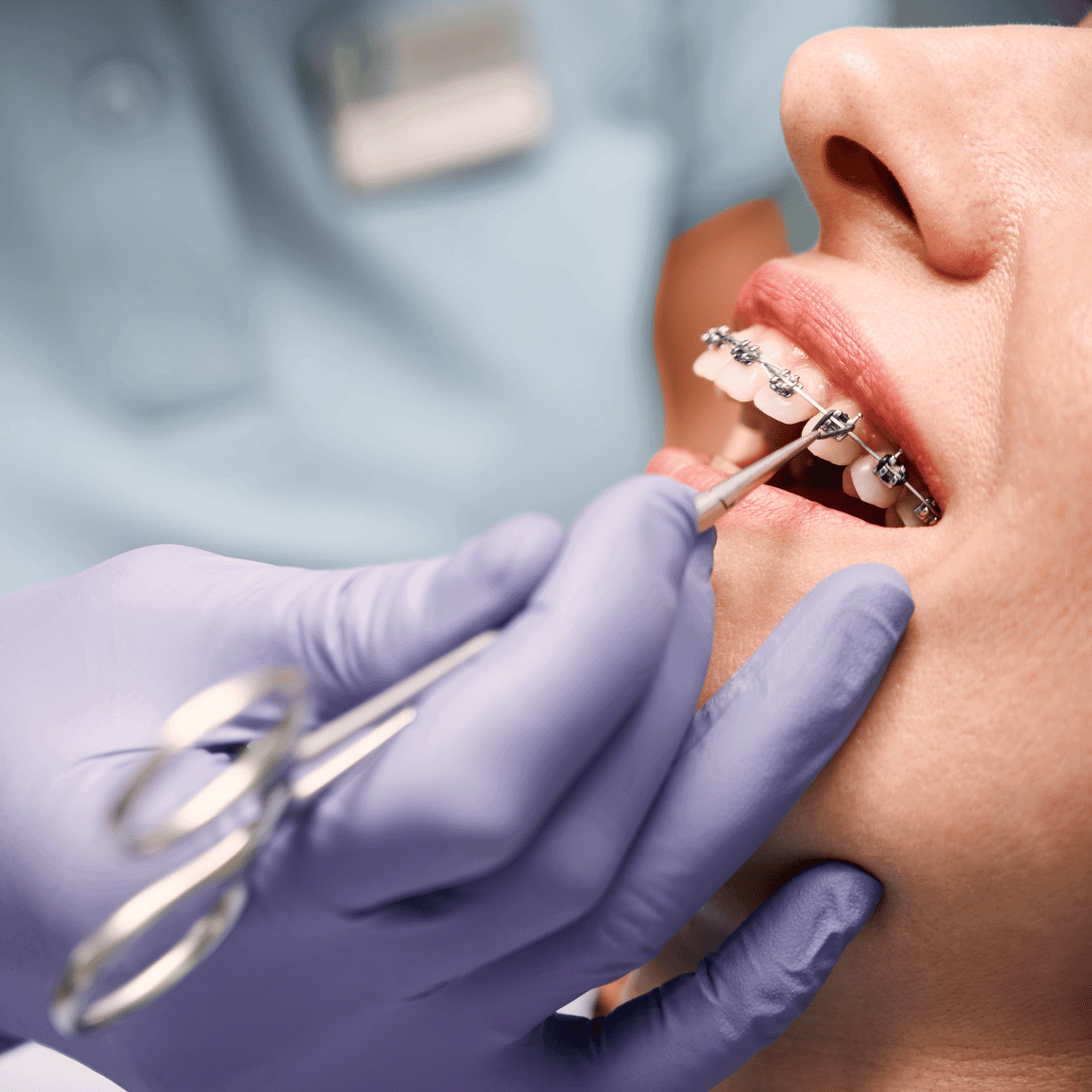 Aparelho odontológico e ortodontia em São Carlos — X-Dent