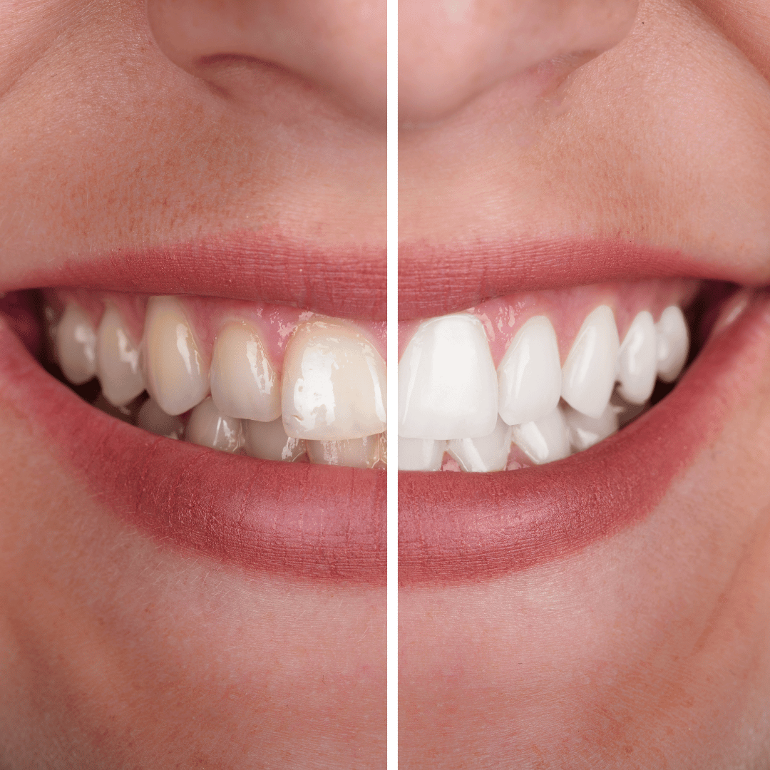 Clareamento dental em São Carlos — X-Dent