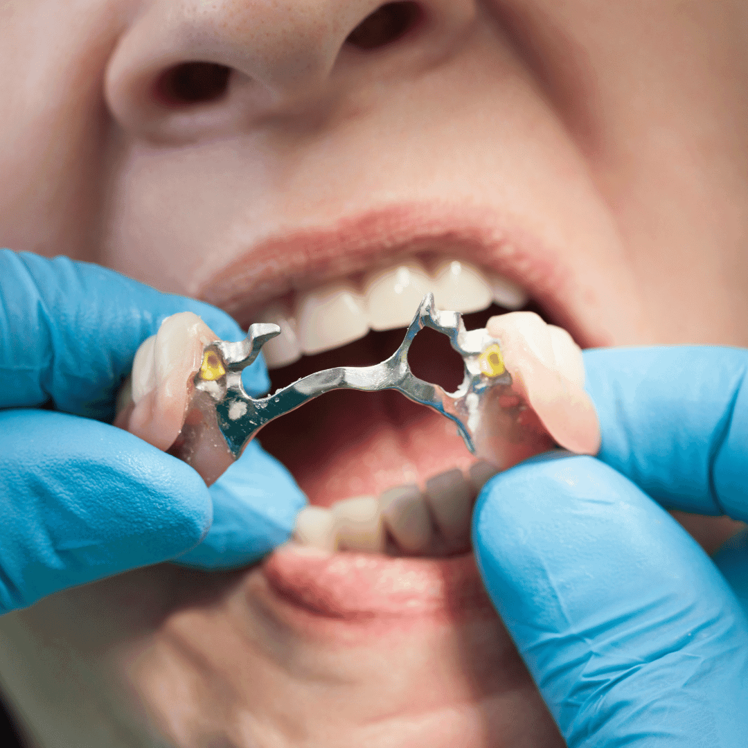 Prótese dentária com escaneamento 3D — X-Dent